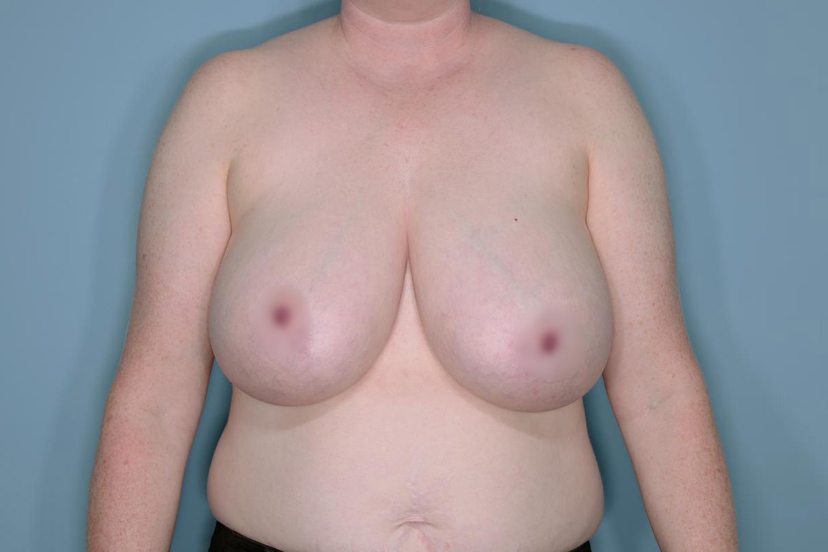 Breast Reduction Before & After Patient #650