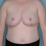 Breast Reduction Before & After Patient #650