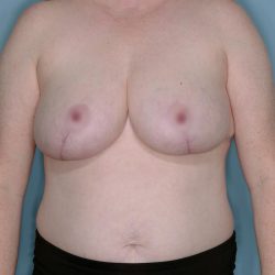 Breast Reduction Before & After Patient #650