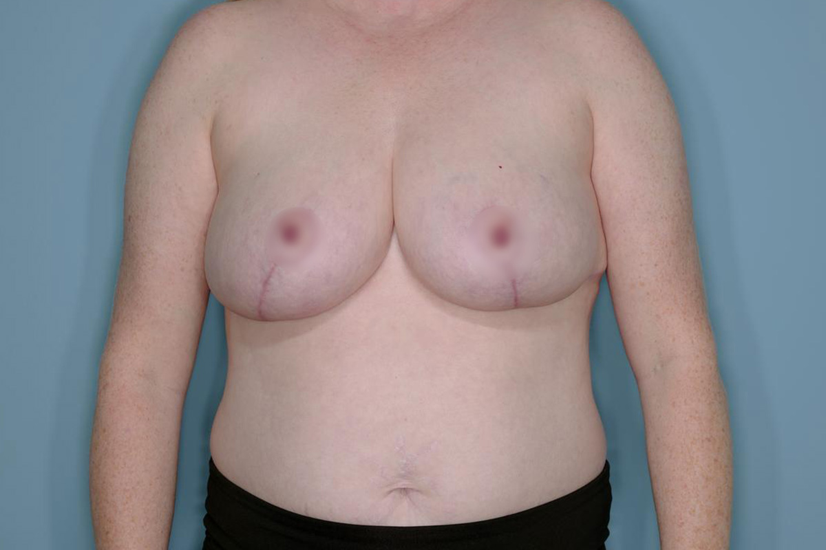 Breast Reduction Before & After Patient #650
