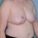 Breast Reduction Before & After Patient #650
