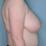 Breast Reduction Before & After Patient #650