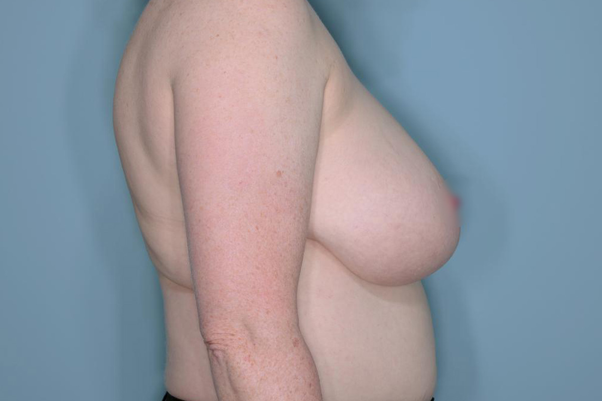 Breast Reduction Before & After Patient #650
