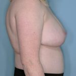 Breast Reduction Before & After Patient #650