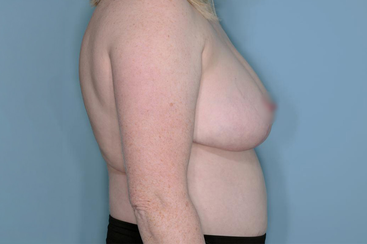 Breast Reduction Before & After Patient #650