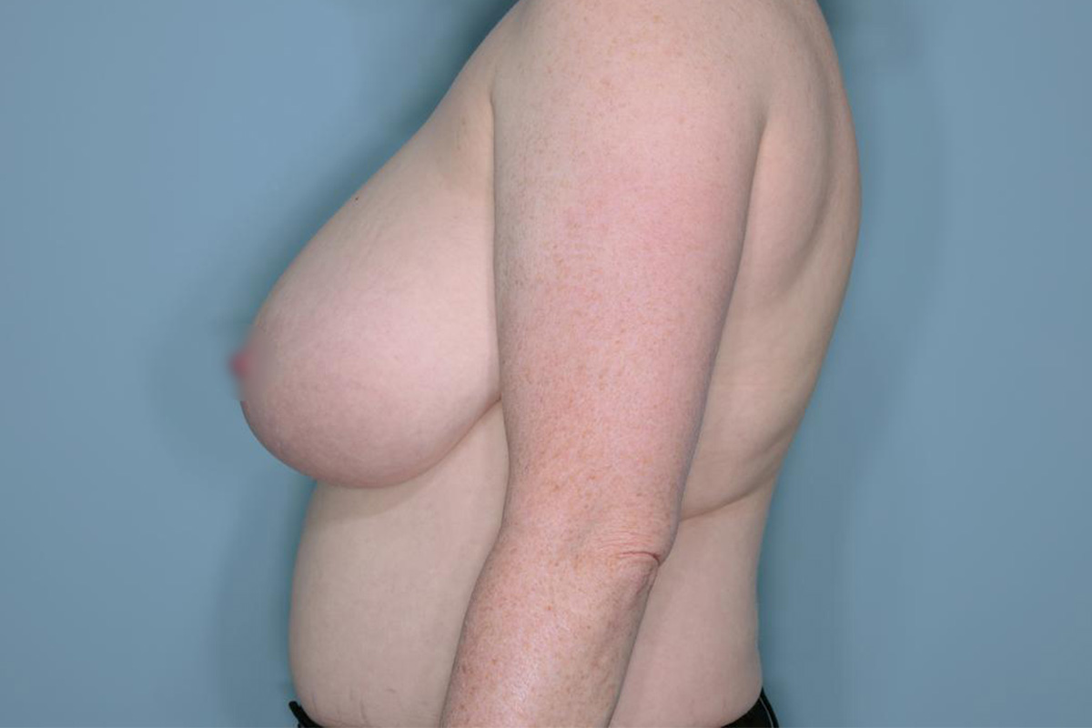 Breast Reduction Before & After Patient #650
