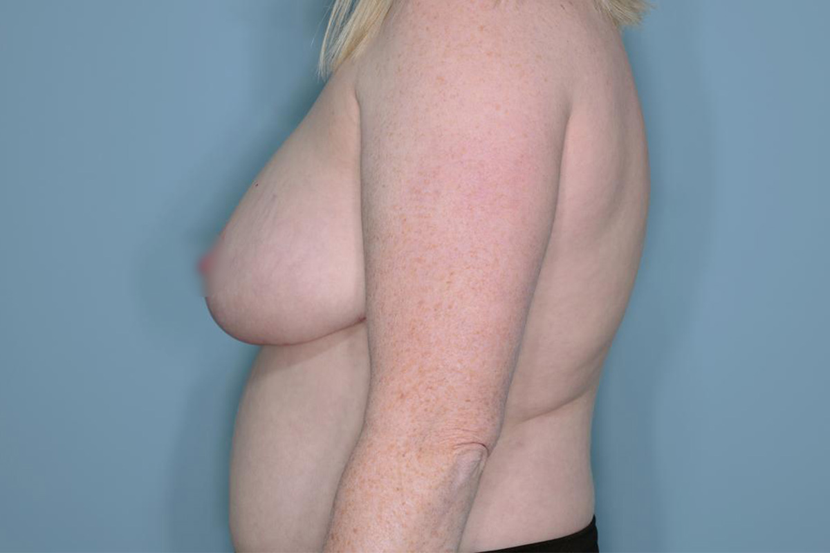 Breast Reduction Before & After Patient #650