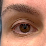 Microneedling Radiofrequency Before & After Patient #805