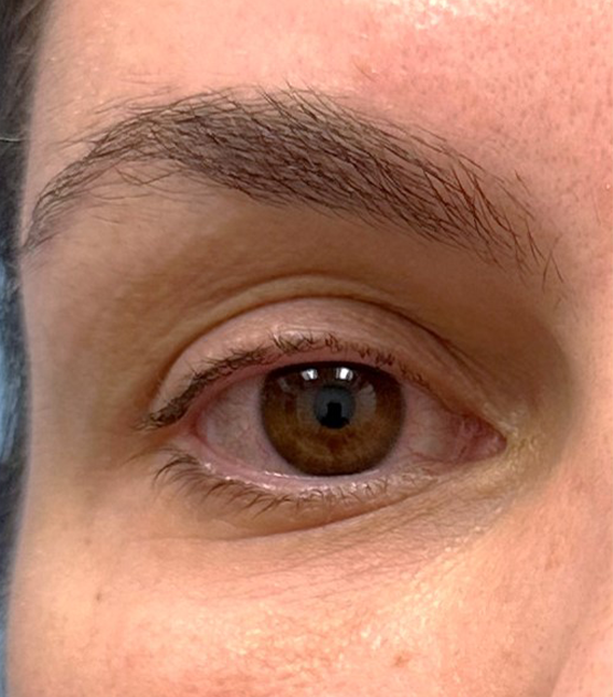 Microneedling Radiofrequency Before & After Patient #805