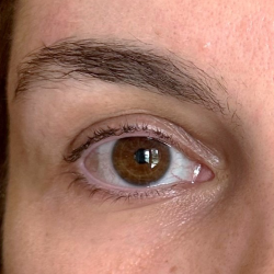 Microneedling Radiofrequency Before & After Patient #805