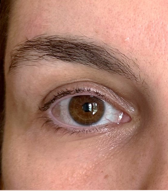 Microneedling Radiofrequency Before & After Patient #805