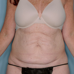 Tummy Tuck Before & After Patient #836