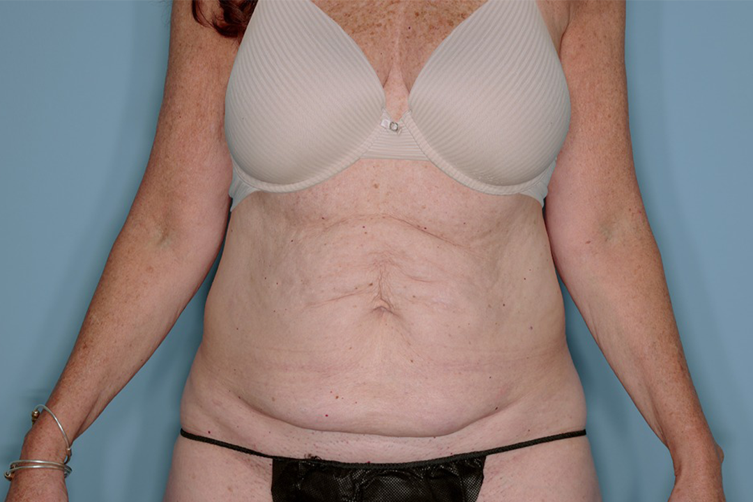 Tummy Tuck Before & After Patient #836