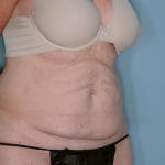 Tummy Tuck Before & After Patient #836