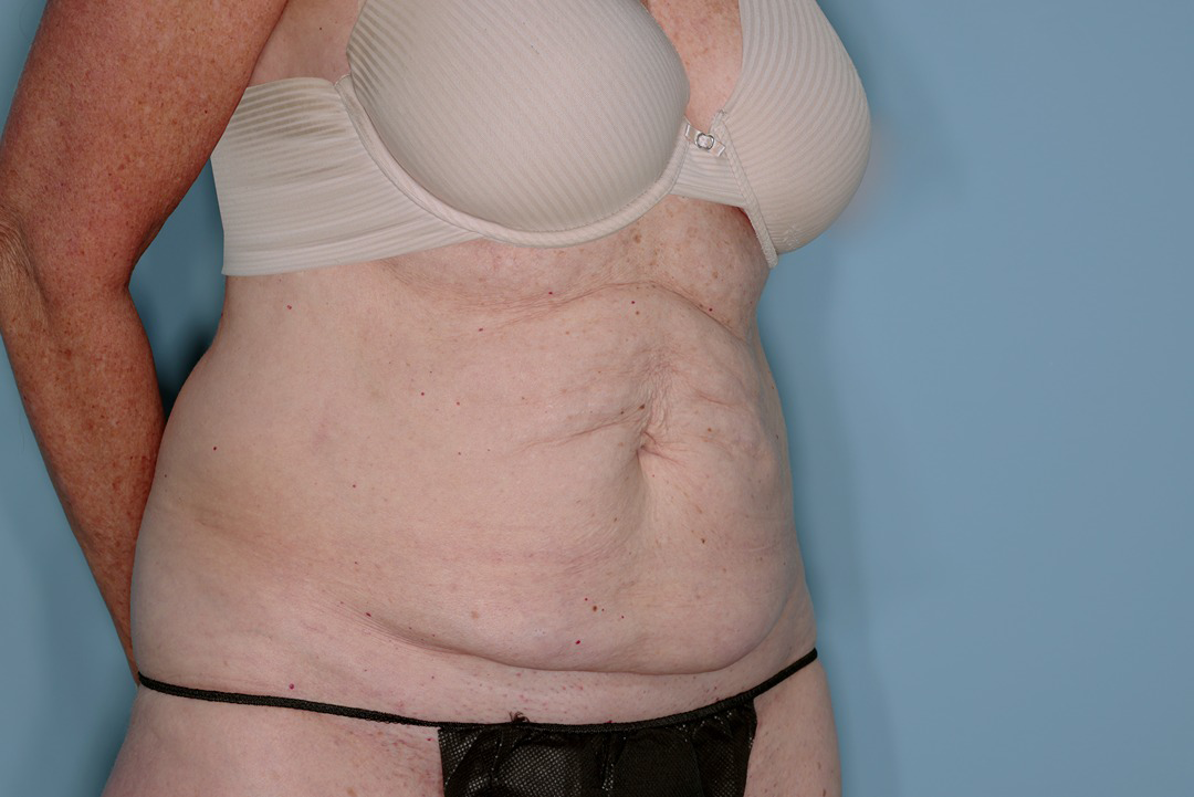 Tummy Tuck Before & After Patient #836