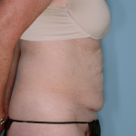 Tummy Tuck Before & After Patient #836