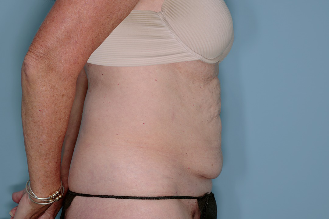 Tummy Tuck Before & After Patient #836