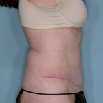 Tummy Tuck Before & After Patient #836