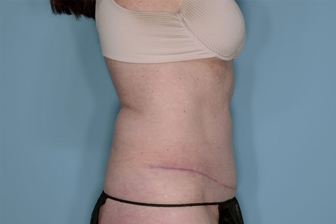 Tummy Tuck Before & After Patient #836