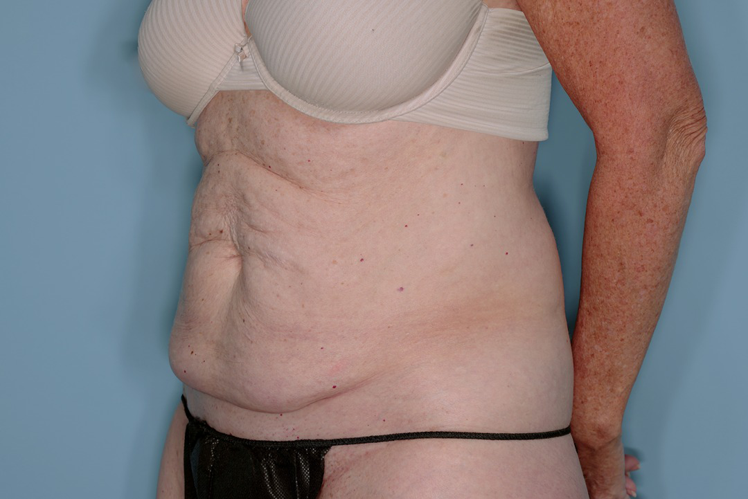 Tummy Tuck Before & After Patient #836