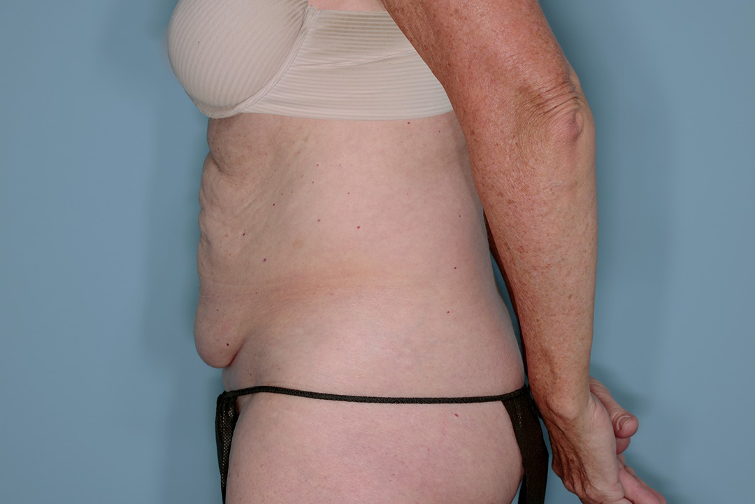Tummy Tuck Before & After Patient #836