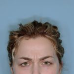 Botox&reg; Before & After Patient #802