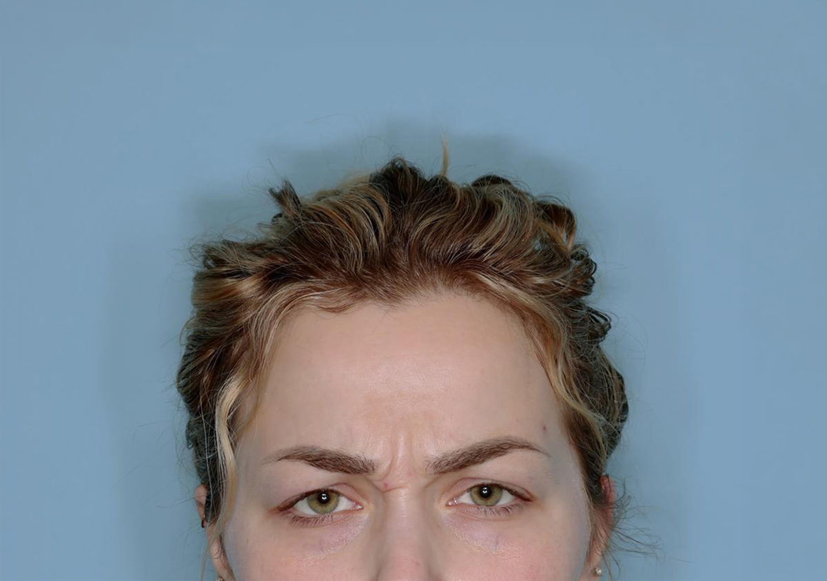 Botox® Before & After Patient #802
