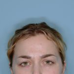 Botox&reg; Before & After Patient #802