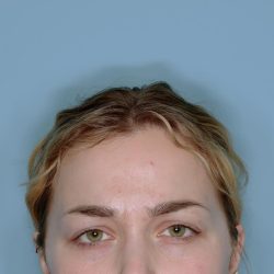 Botox® Before & After Patient #802