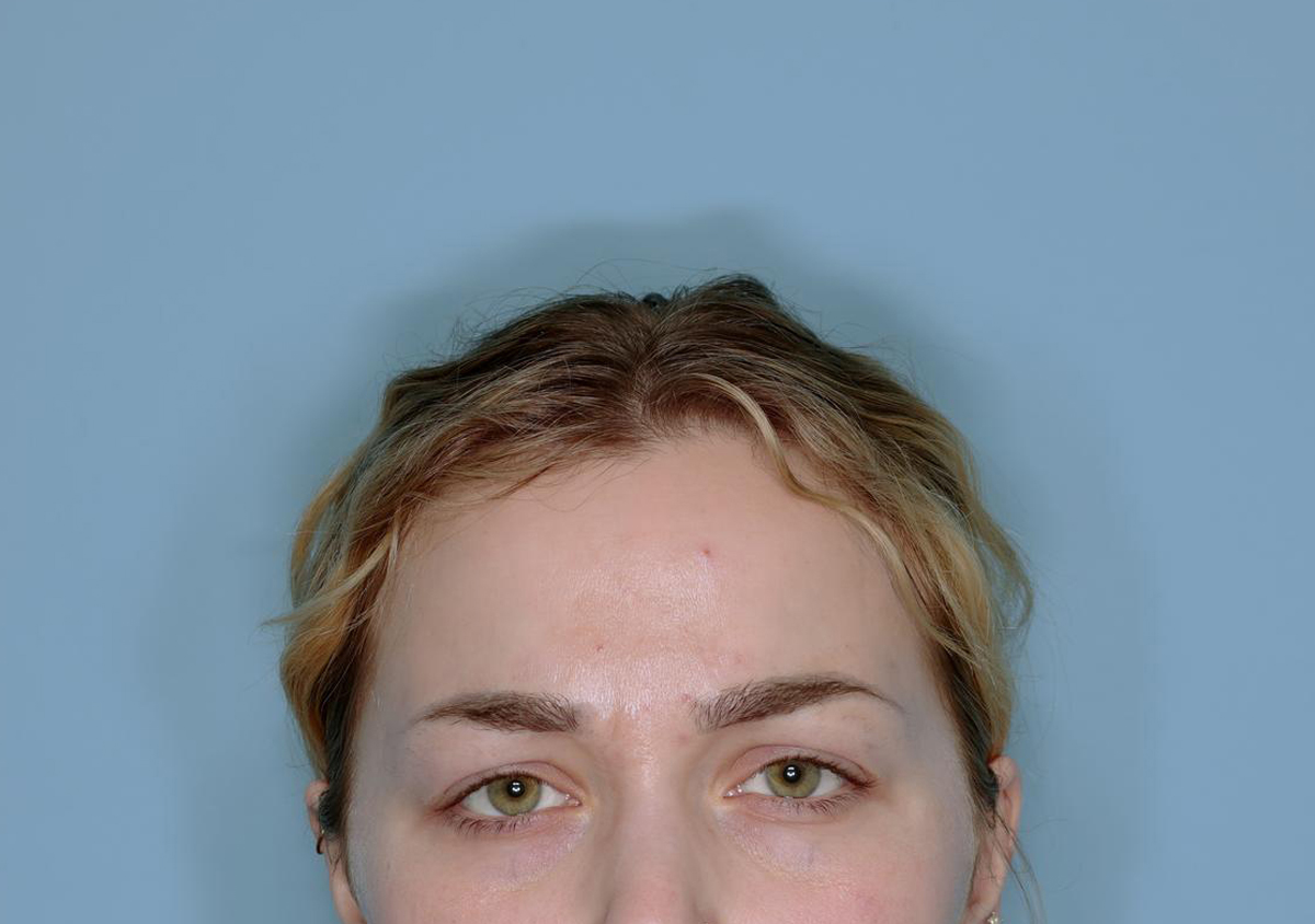 Botox® Before & After Patient #802