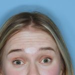 Botox&reg; Before & After Patient #800