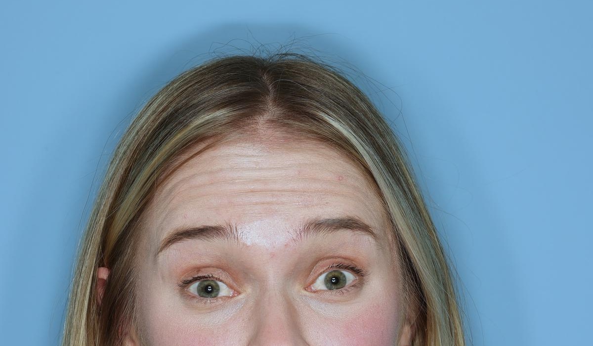 Botox® Before & After Patient #800