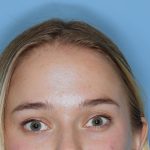 Botox&reg; Before & After Patient #800