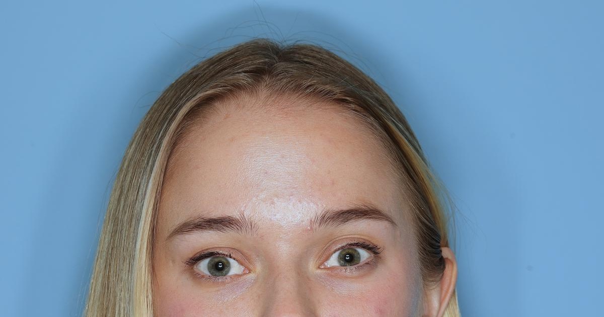 Botox® Before & After Patient #800