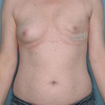 Breast Reconstruction Before & After Patient #803