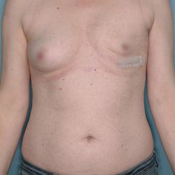 Breast Reconstruction Before & After Patient #803