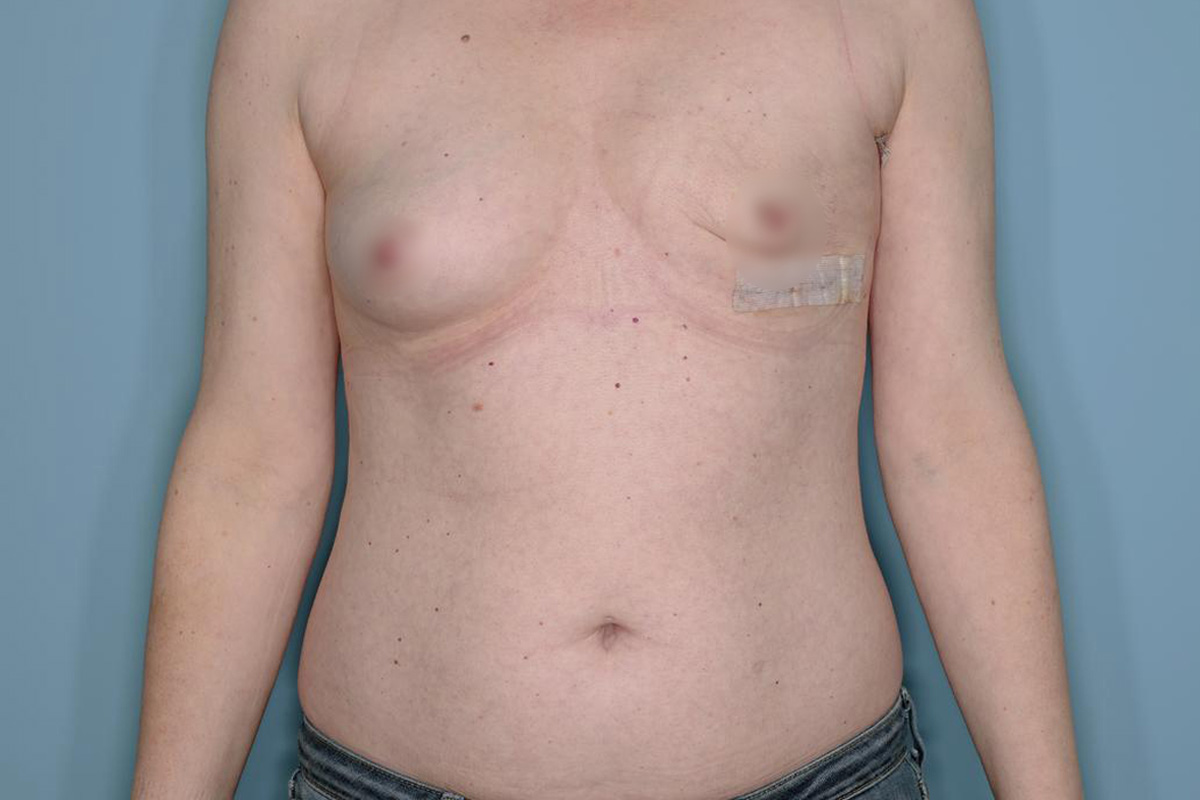 Breast Reconstruction Before & After Patient #803
