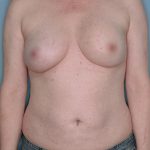 Breast Reconstruction Before & After Patient #803