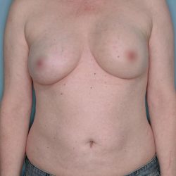 Breast Reconstruction Before & After Patient #803
