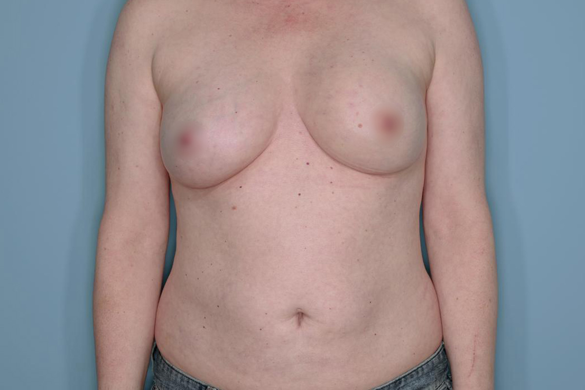 Breast Reconstruction Before & After Patient #803