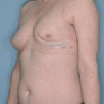 Breast Reconstruction Before & After Patient #803