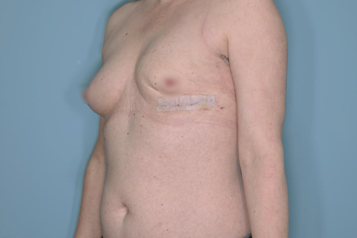 Breast Reconstruction Before & After Patient #803