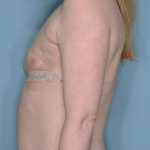 Breast Reconstruction Before & After Patient #803