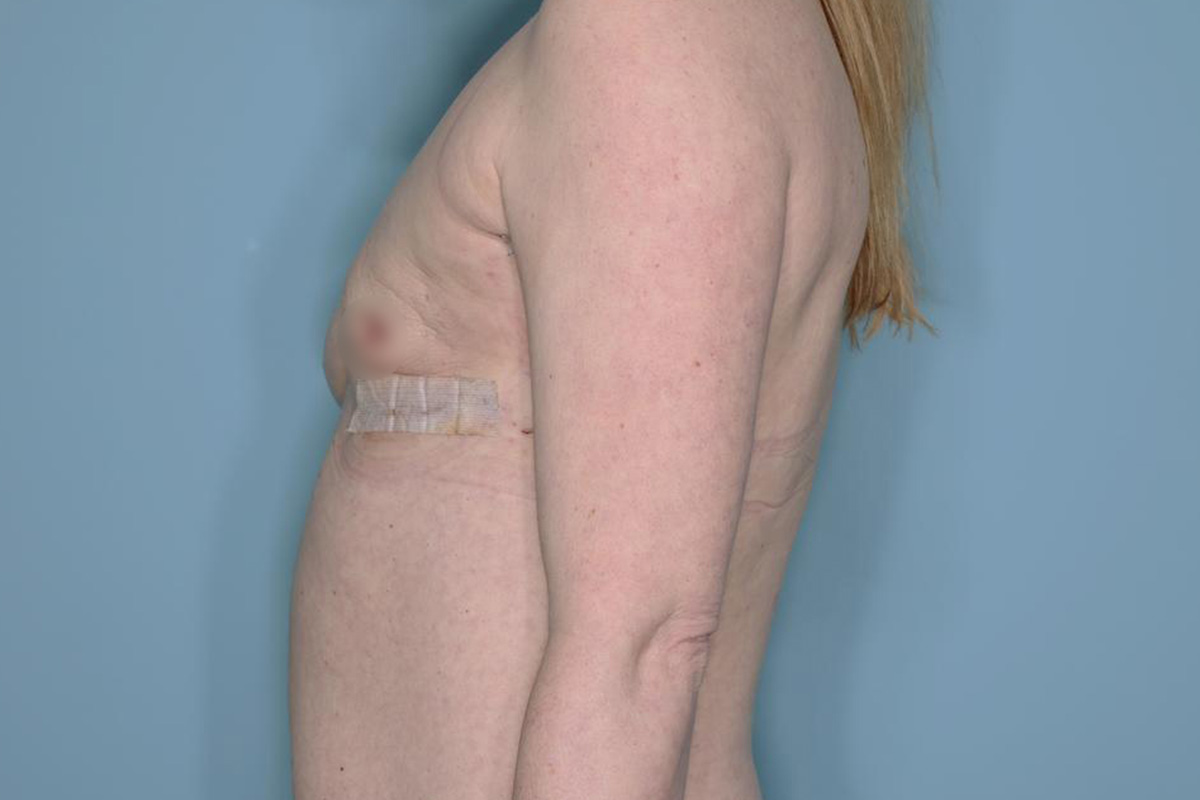 Breast Reconstruction Before & After Patient #803