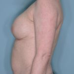 Breast Reconstruction Before & After Patient #803