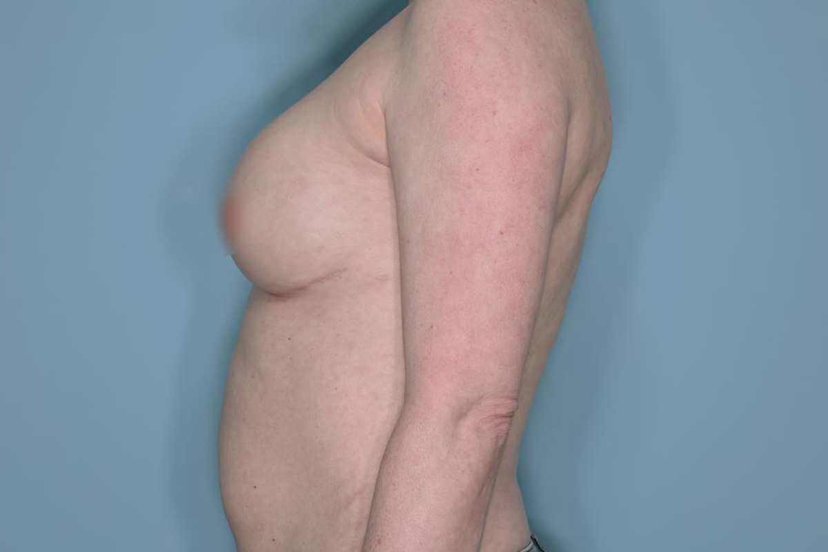 Breast Reconstruction Before & After Patient #803