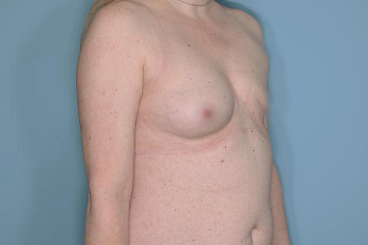 Breast Reconstruction Before & After Patient #803