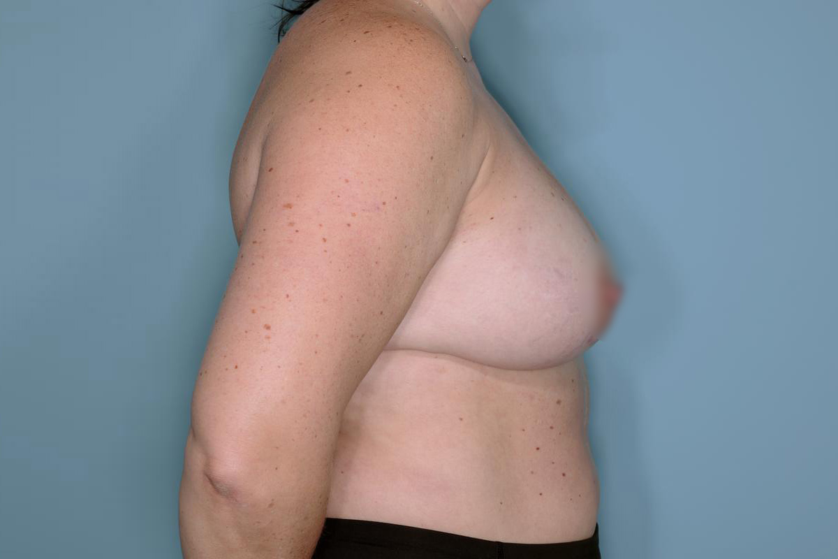 Breast Reconstruction Before & After Patient #804