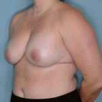 Breast Reconstruction Before & After Patient #804
