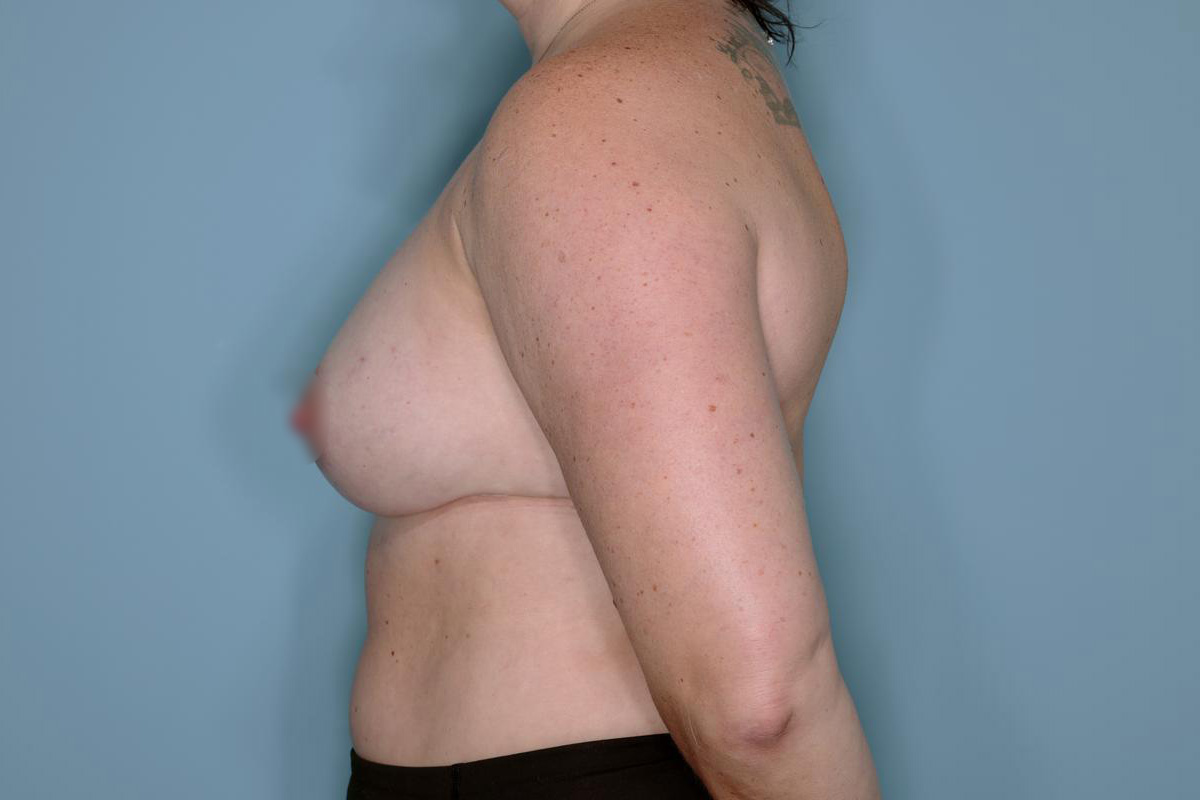 Breast Reconstruction Before & After Patient #804